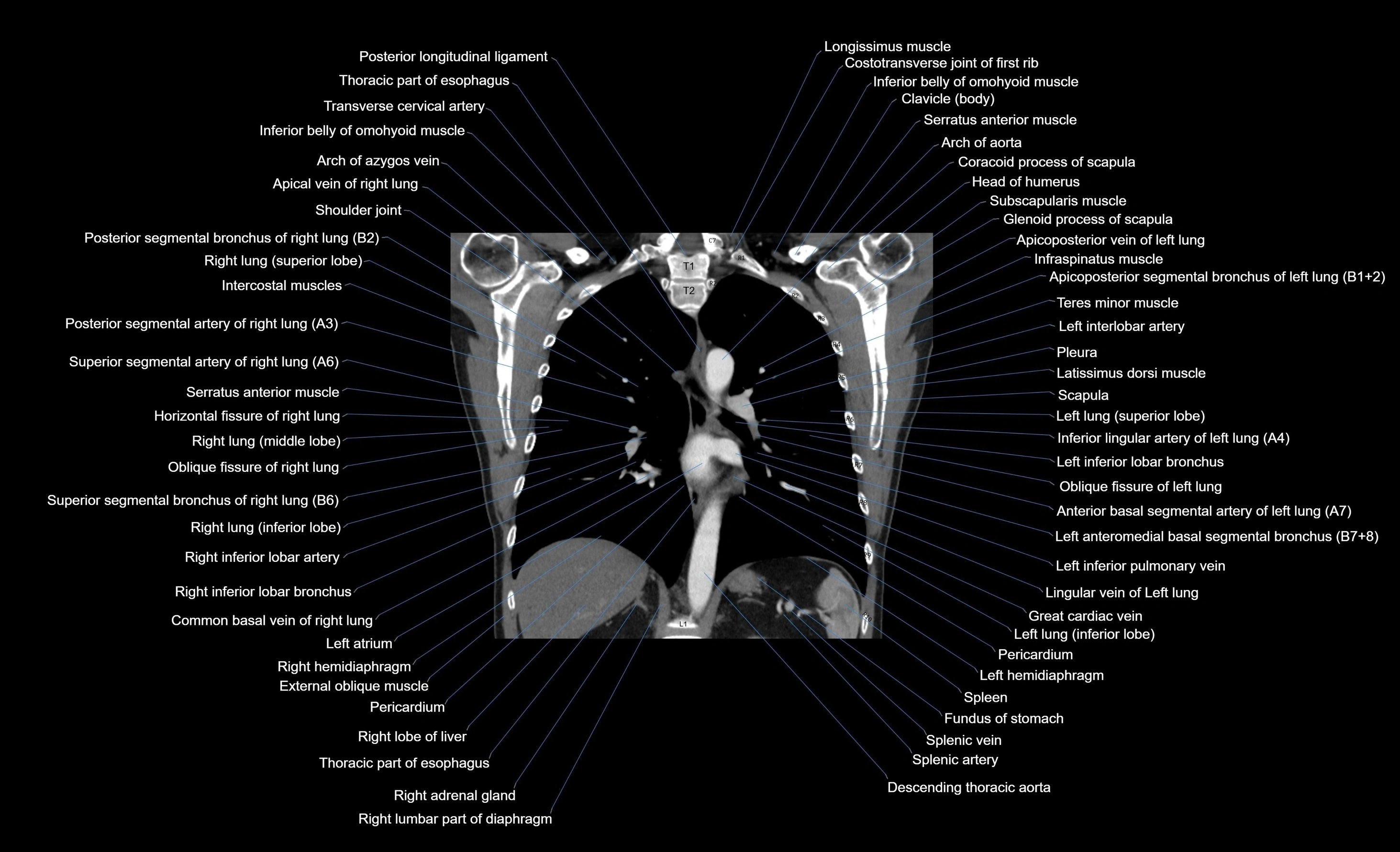 CT chest (thorax) labelled coronal cross sectional anatomy radiology image-00051.webp